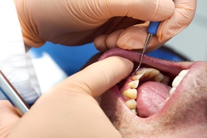 A man having his gums cleaned