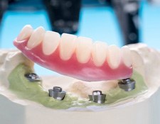 A model denture resting on top of dental implants imbedded in the plaster base