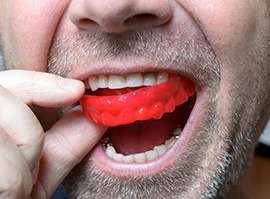 Man removing red mouthguard from upper arch