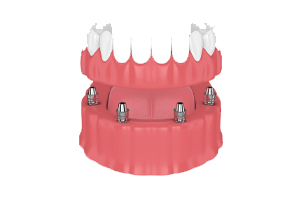 implant-retained denture