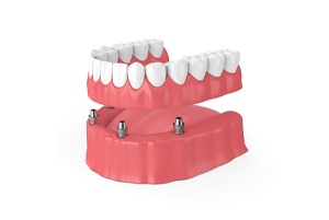 implant-supported denture