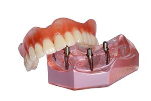 Implant denture