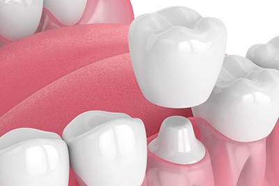 Diagram showing how a dental crown in Crown Point works