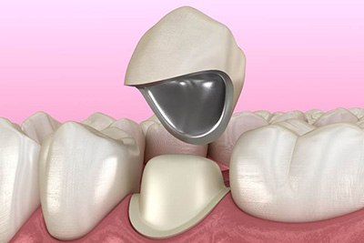 Diagram showing how a dental crown in Crown Point works