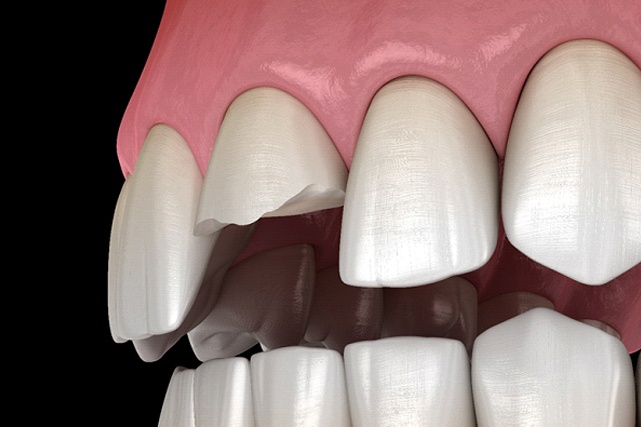 computer model of a broken tooth