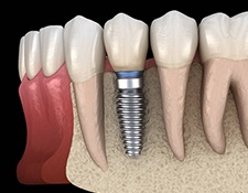 dental implant post in the jawbone 