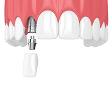 dental implant being placed in the upper jaw 