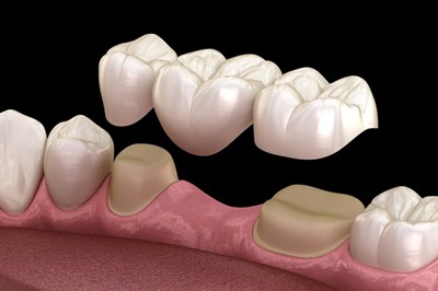 A diagram of a dental bridge.