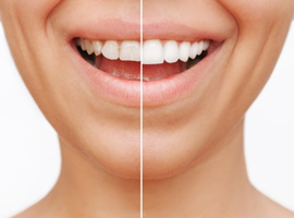 Patient's smile before and after veneers