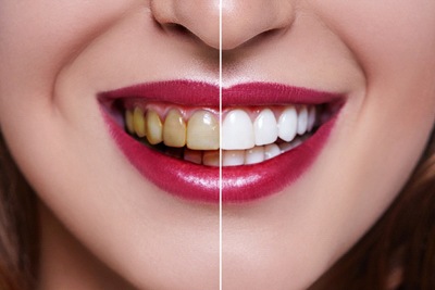 Smiling woman holds before photo after teeth whitening in Whiting.