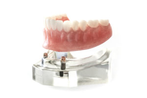 Model of a denture attached to implants