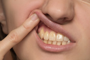 woman with bacteria under gumline