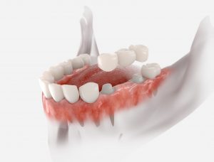 CGI illustration of a dental bridge over abutments in a lower arch