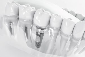 Black and white 3D image of a dental implant