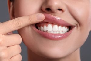 Lower half of a woman's face showing her smiling and pushing her lip up with her pointer to show her gums